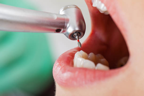 Best Emergency Wisdom Teeth Removal in Fair Oaks, GA